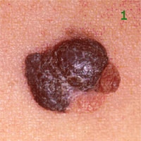 images melanomul malign